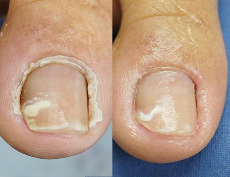 Peeling Químico para Onicofose